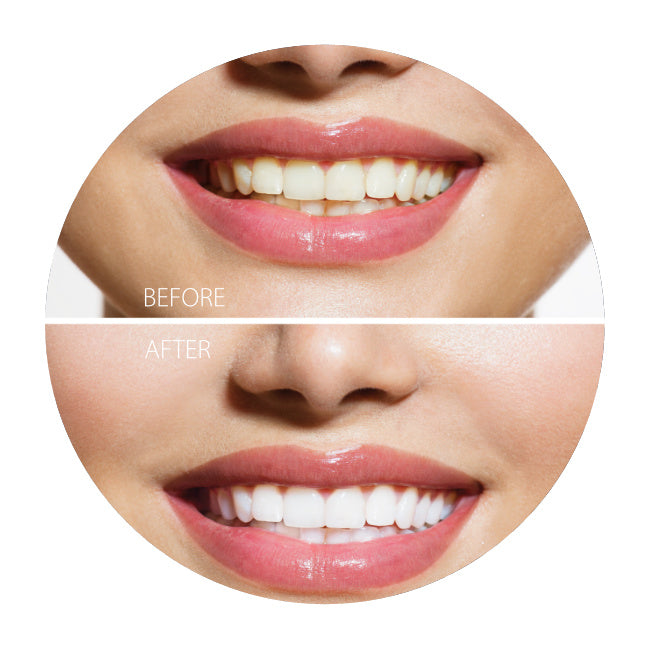 Onuge Bright White-Strips | 28 Streifen (14 Tage)